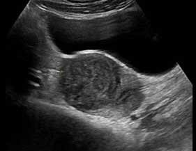 Intramural fibroids