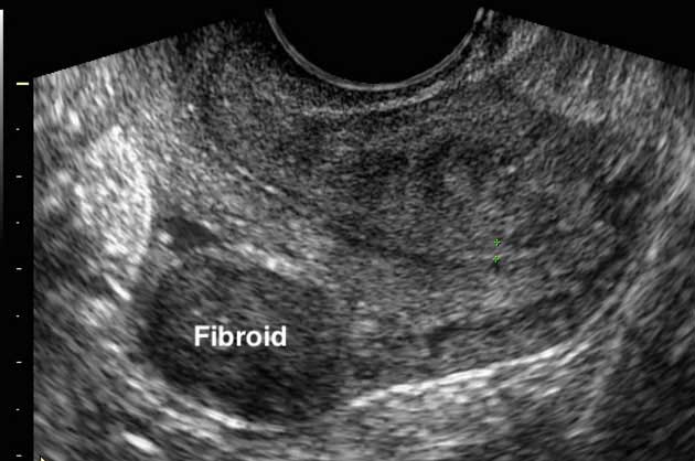 Intramural fibroids