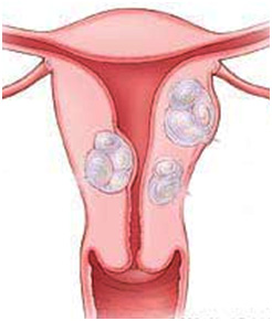 What is uterine fibroid