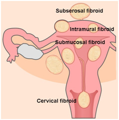 Symptoms of fibroids