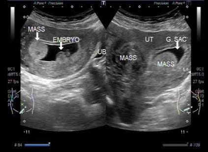 pregnancy-ultrasound-with-fibroids