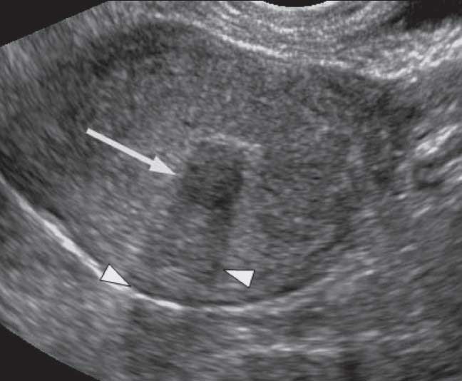 Submucosal-fibroids