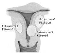 Symptoms of fibroids