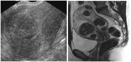 Diagnosis of Uterine Fibroid