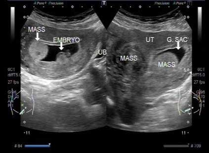 pregnancy-ultrasound-with-fibroids